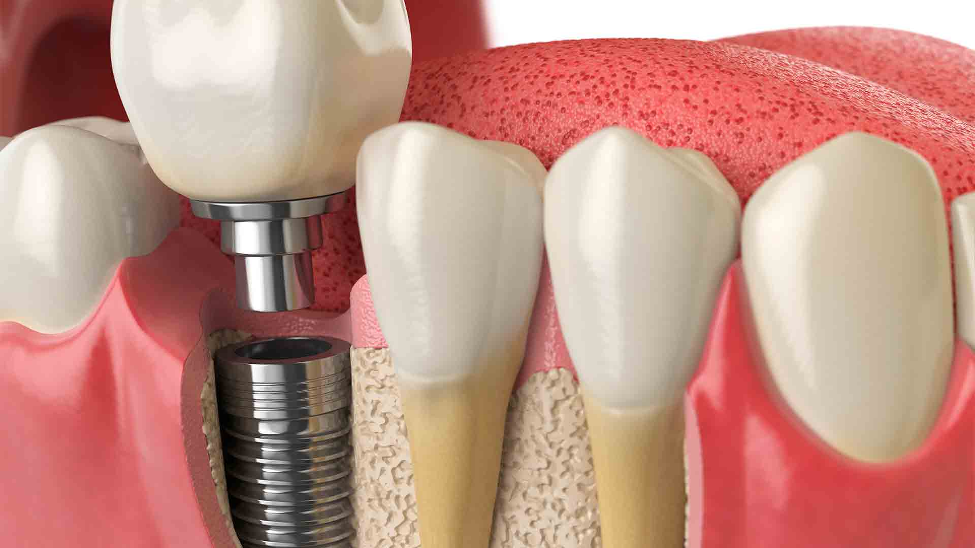 ▷ ODONTOLOGÍA 3D 🦷 Imágenes dentales 3D y Vídeos