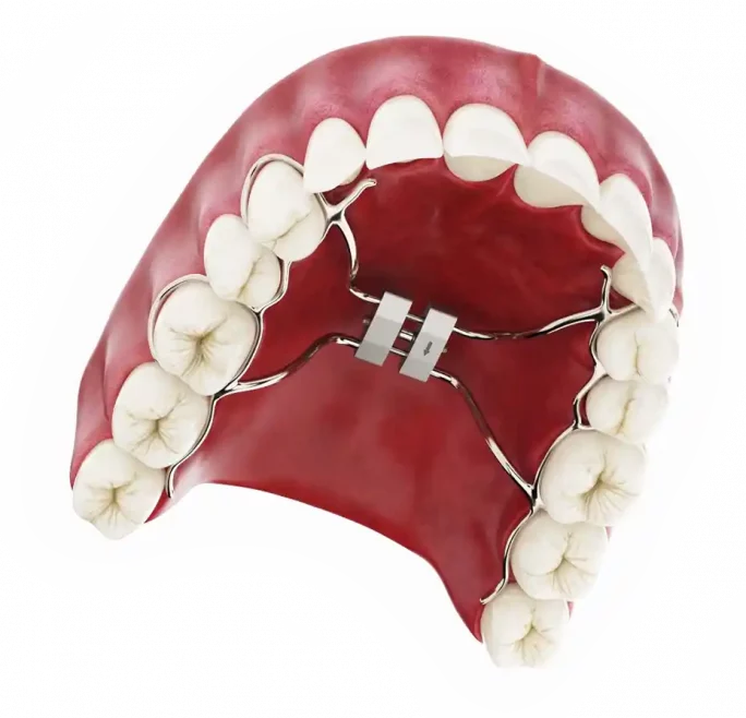 Expansor de paladar para dientes en 3D odontología odontólogo clinica dental