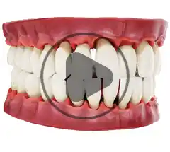Video enfermedad periodontal