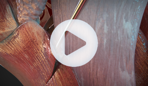 Cirugía estética Cuello - Recreación en Animación 3D- Grupo Audiovisual Play Video