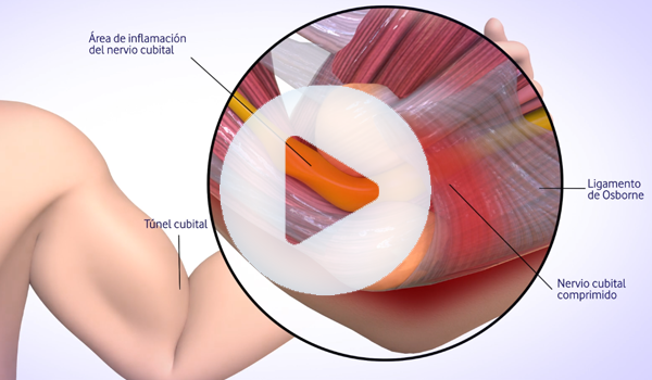 SINDROMES CANALICURARES medicina salud pharma grupo audiovisual Play Video