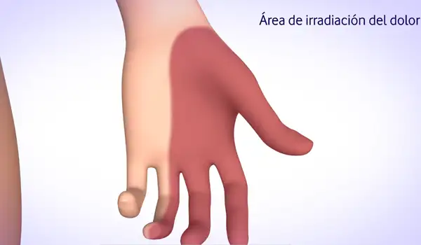 Imagen de proyecto Animación 3D Médica sobre Radiculopatías y Síndromes Canaliculares Grupo Audiovisual 05